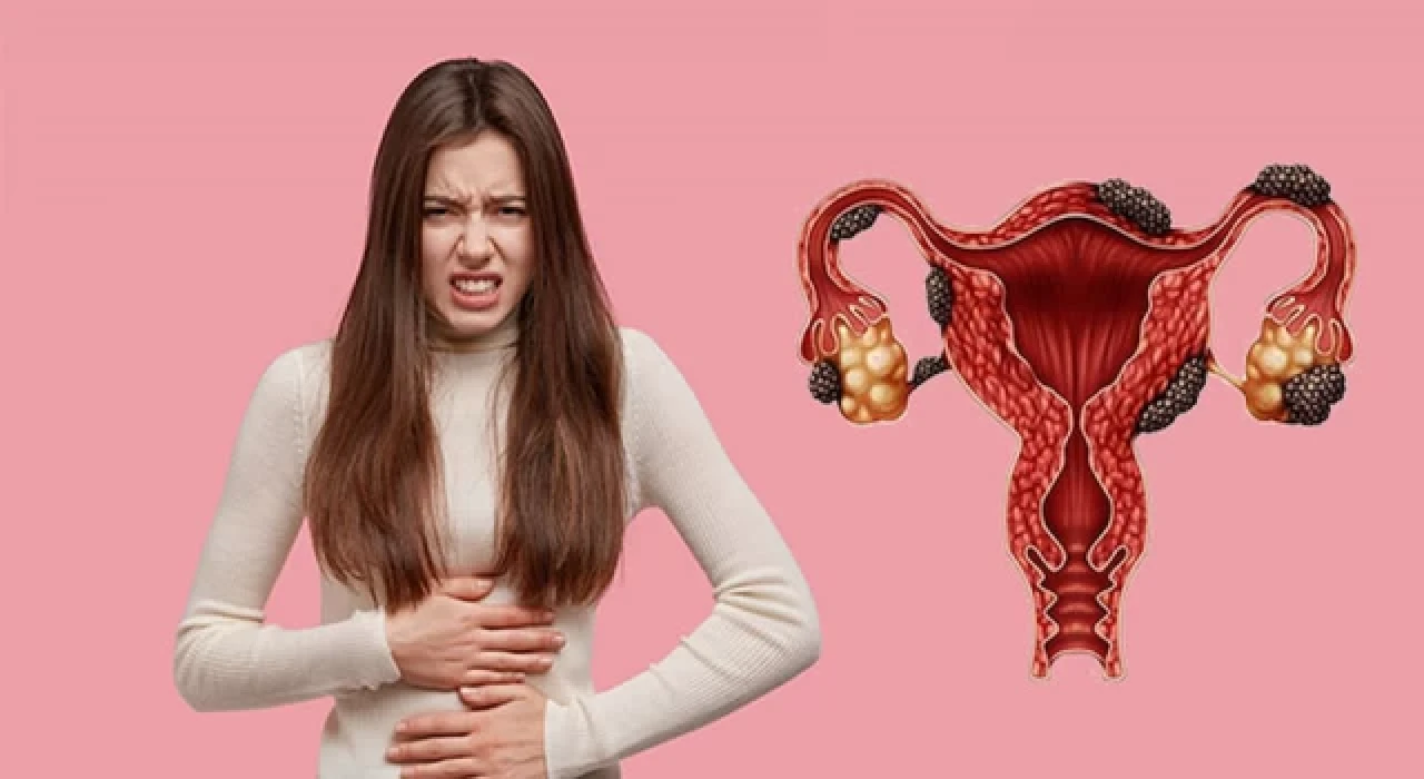 Çikolata kisti (endometriozis) önemli hastalıklara neden olabilir