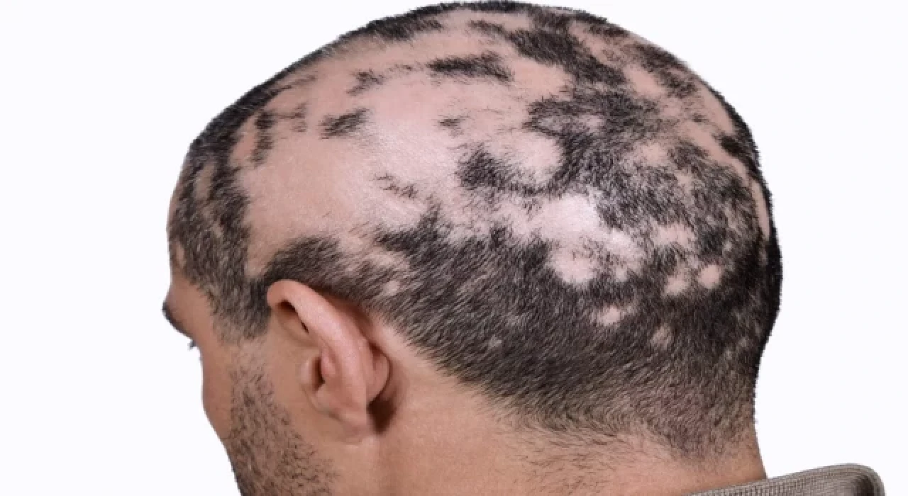 Saçkıran ya da Alopesi nedir?