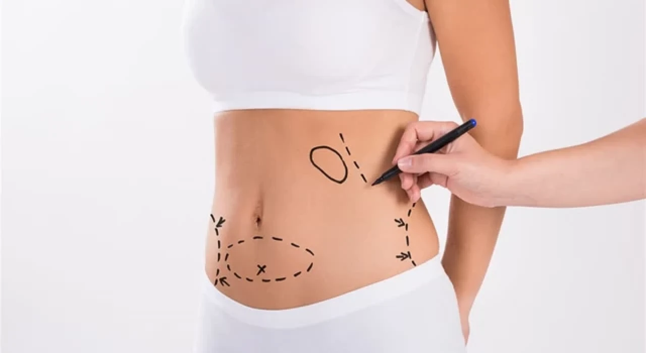 Liposuction Nedir? Hangi Durumlarda Yapılır?