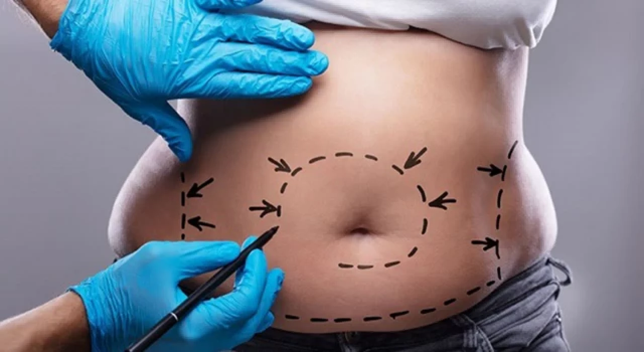 Güzelliğin Formülü Liposuction ile İdeal Vücut Konturu