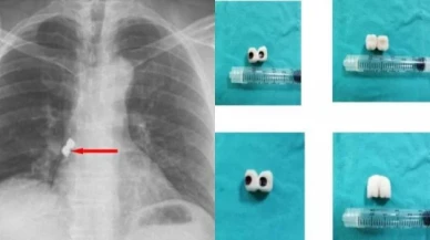 Afyonkarahisar’da, bir şahsın soluk borusuna diş tedavisi sırasında 2 implant kaçtı