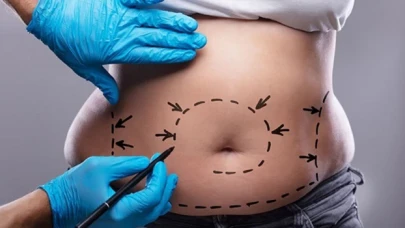 Güzelliğin Formülü Liposuction ile İdeal Vücut Konturu