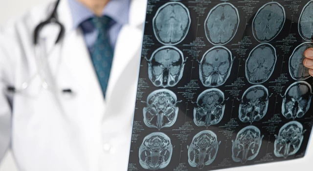 Dünyada bir ilk: Yeni beyin kanseri tedavisi başarılı oldu
