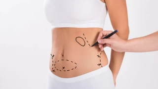 Liposuction Nedir? Hangi Durumlarda Yapılır?